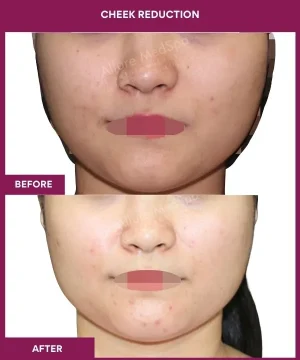12 Cheek Reduction_31_
