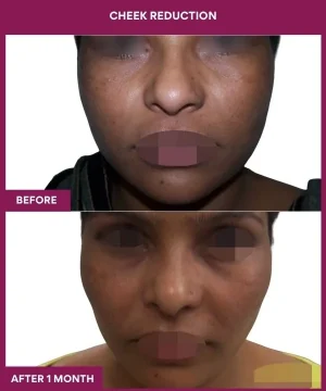 13 Cheek Reduction_32