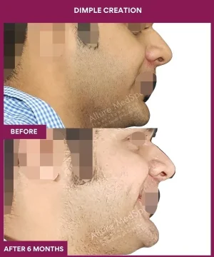 Male Dimple Creation in Mumbai, India