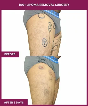 2 100+ Lipoma Removal Surgery (2)
