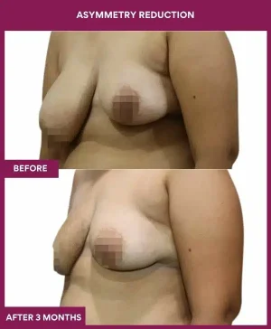 2 Asymmetry Reduction (2)