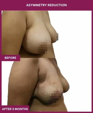 2 Asymmetry Reduction (3)