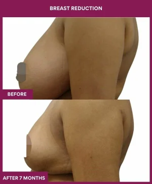 2 BREAST REDUCTION (2)