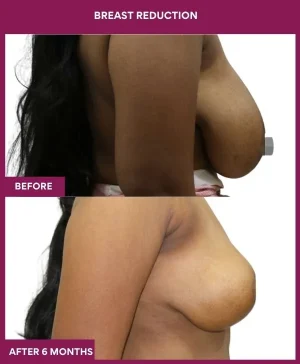 2-Breast Reduction_6_ (2)