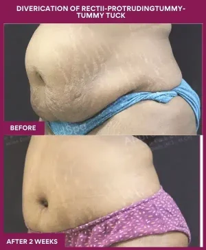 2 DIVERICATION OF RECTII-PROTRUDINGTUMMY- TUMMY TUCK_6_ (6)