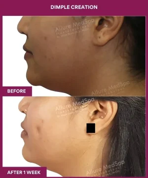 Dimple Creation Surgery in Mumbai, India