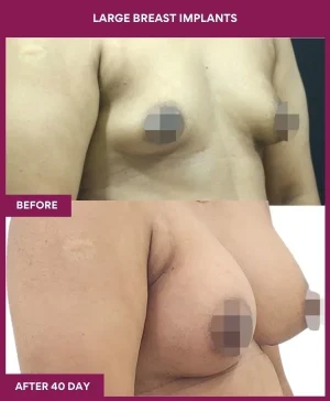 2 Large Breast Implants (3)_5_