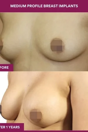 2 Medium Profile Breast Implants (2)_4