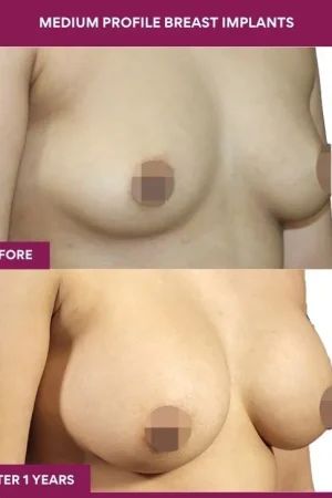 2 Medium Profile Breast Implants (3)_5