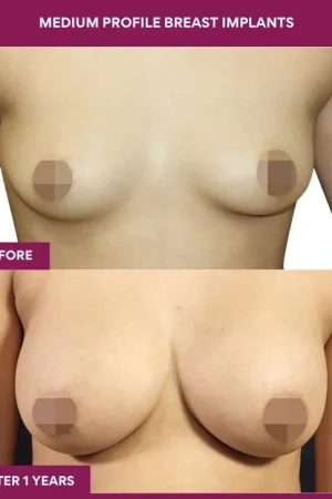 2 Medium Profile Breast Implants_6