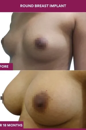 2 Round breast implant_6_ (3)