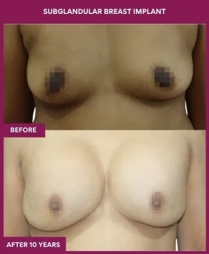 2 SUBGLANDULAR BREAST IMPLANT (4)_5