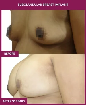 2 SUBGLANDULAR BREAST IMPLANT (5)_5