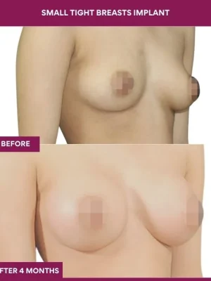 2 Small Tight Breasts Implant (3)_5_