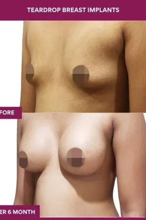 2 Teardrop Breast Implants (3)_5