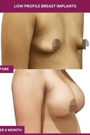 2 low Profile Breast Implants (2)_4
