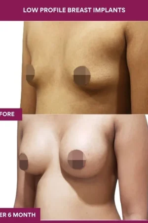 2 low Profile Breast Implants (3)_5