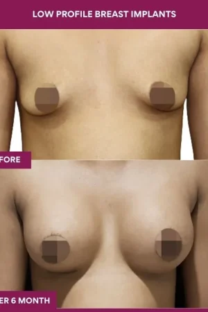 2 low Profile Breast Implants_6