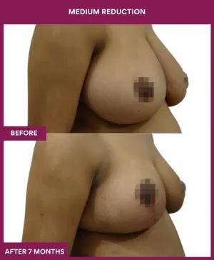 2 medium reduction (3)