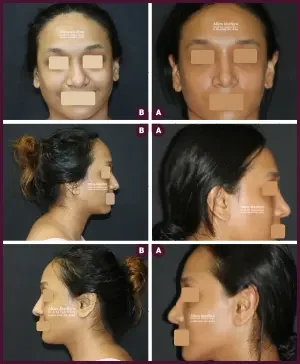2018-04-031-COMPLETE-RHINOPLASTY-2