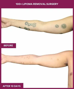 3 100+ Lipoma Removal Surgery