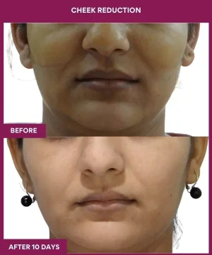 3 Cheek Reduction_8_