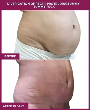 3 DIVERICATION OF RECTII-PROTRUDINGTUMMY- TUMMY TUCK (2)_7_