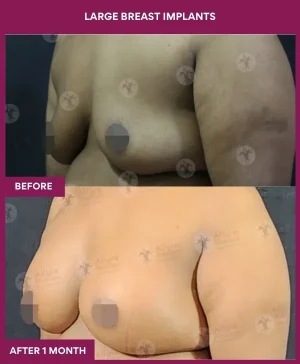 3 Large Breast Implants (3)_8