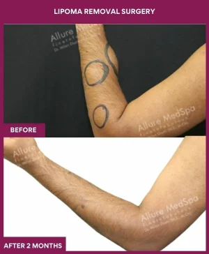 3 Lipoma Removal Surgery (2)