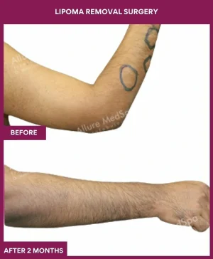 3 Lipoma Removal Surgery (3)