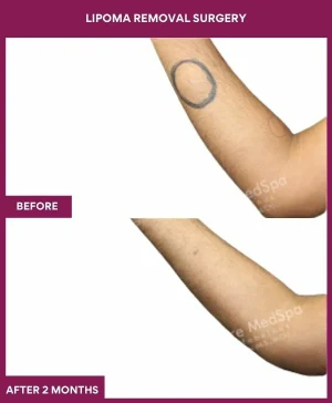 3 Lipoma Removal Surgery