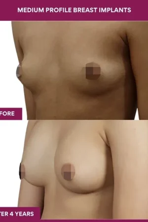 3 Medium Profile Breast Implants (2)_7