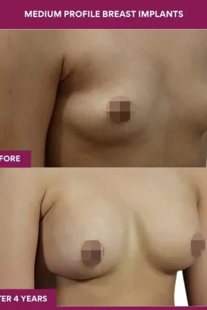 3 Medium Profile Breast Implants (3)_8