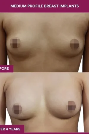 3 Medium Profile Breast Implants_9