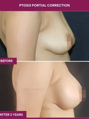 3 Ptosis Portial Correction (3)_8_