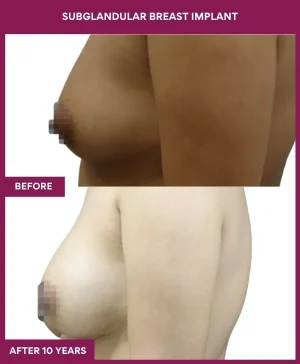3 SUBGLANDULAR BREAST IMPLANT_9_ (3)