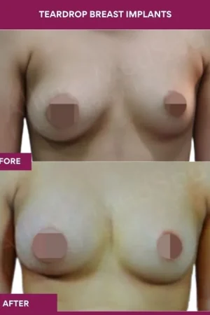 3 Teardrop Breast Implants_9 (1)