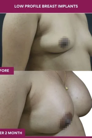 3 low Profile Breast Implants (2)_7