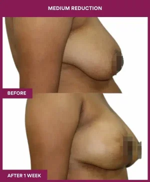 3 medium reduction (2)