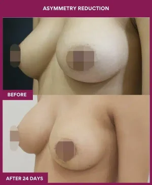 4 Asymmetry Reduction (3)