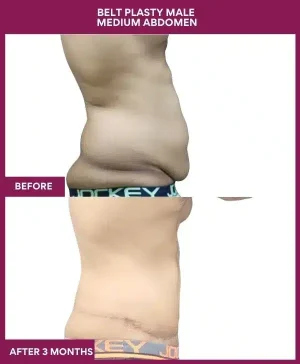 4 BELT PLASTY MALE MEDIUM ABDOMEN (5)_11