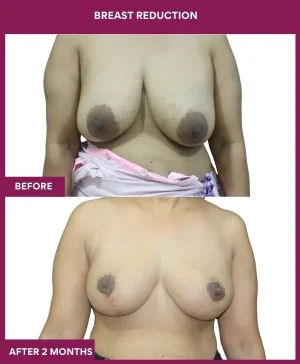 4-Breast Reduction_12_ (1)
