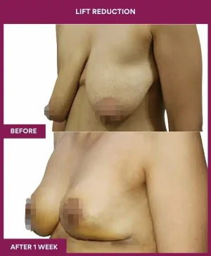 4 Lift reduction (3)