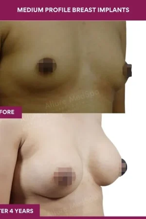 4 Medium Profile Breast Implants (2)_10