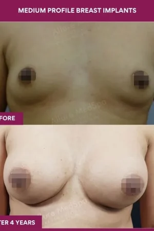 4 Medium Profile Breast Implants_12