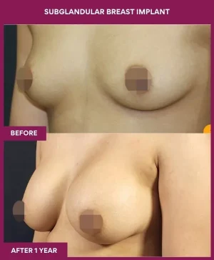 4 SUBGLANDULAR BREAST IMPLANT_11 (3)