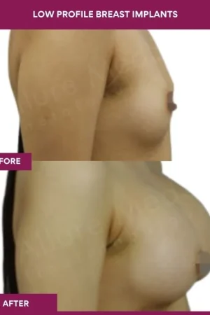 4 low Profile Breast Implants (2)_10