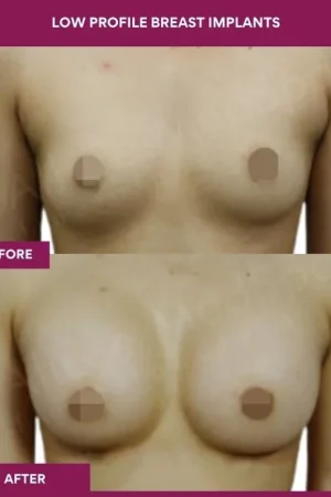4 low Profile Breast Implants_12