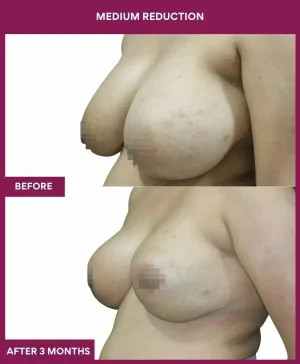 Medium Reduction Surgery in Mumbai, India
