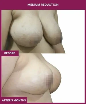 Medium Reduction Surgery in Mumbai, India